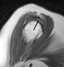 sagittal MR görüntüde tendonda dejenerasyona ba l sinyal art fl (siyah ok), tendon ile deltoid kas aras nda lineer hiperintens peribursal ya dokusunun korundu u izleniyor.