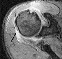 ekleminde ( f ) dejeneratif artrit bulgular.