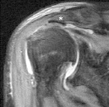 supraspinatus tendonu izlenemiyor ve humerus bafl düzensiz; ( d ) transvers planda sa
