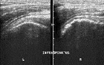 lamal ) aksiyel MR görüntüde infraspinatus tendonu düzensiz ve tendon içi sinyal art