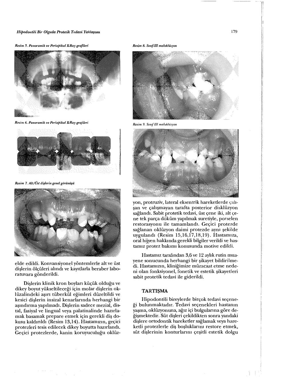 Hipodontili Bir Olguda Protetik Tedavi Yaklaşımı 179 Resim 5. Panoramik ve Periapikal X-Ray grafileri Resim 8. Sınıf III malokiüıyoıı Remıı 6. Panoramik ve Penaptkal X-Ray grafileri Resim 7.