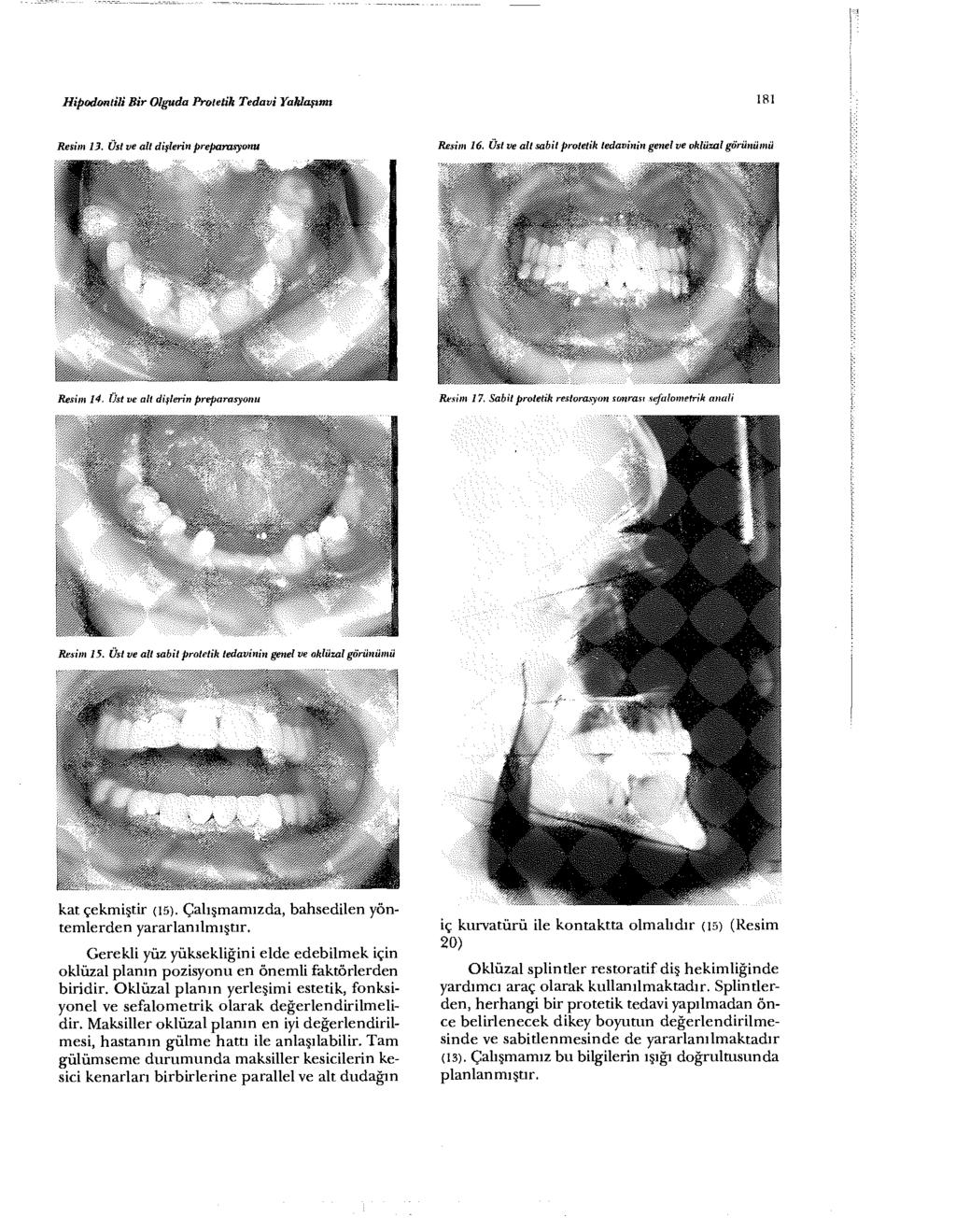 Hİpodontili Bir Olguda Protetik Tedavi Yaklaşımı 181 Resim 13. Üst ve alt dişlerin preparasyonu Resim 16. Üst ve alt sabit protetik tedavinin genel ve oklüzal görünümü Wm$Mm Re^ım 14 l Resim 17.