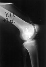 Sözen ve ark. Diz eklemindeki tip 4 osteokondritis dissekans n iki aflamal tedavisi 267 Hastaya önce tan sal artroskopi yap ld.