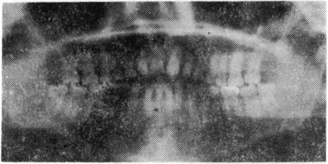 Cilt 13. Sayı 1 DİNÇER, DELİLBAŞI, YAMALIK Resim 3. Vakanın tedavi başı panoramik film görüntüsü. dişlerde protrüzyon (1N-NA.-6.