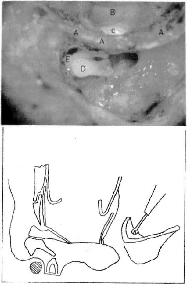 Kulak arkası kesinin kapatılması. A Musculo-periosteal yaprak B Lastik dren C Kulak arkası deriş» quet-perkins yöntemine göre iki ayrı basamaktan ibarettir (15, 19).