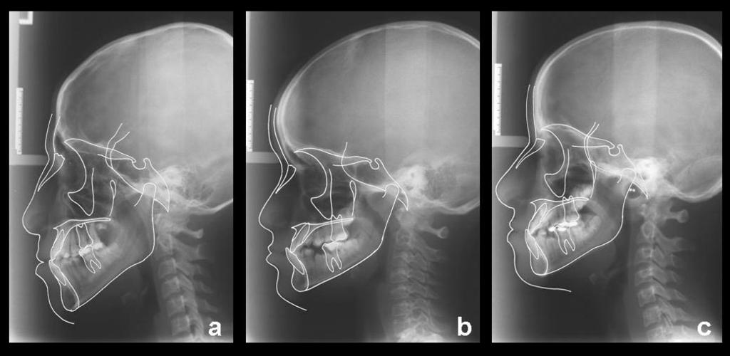 Altu -Ataç, Kurt INTRODUCTION Significant relationship between the nasopharyngeal and dental-craniofacial structures has been reported (1-6).