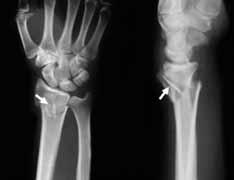 204 Acta Orthop Traumatol Turc (a) (b) Radius alt uç k r klar nda tedavinin amac, radius alt ucunda minimal k salma ile iyileflme sa lanmas, radial e im ve palmar e im aç lar n n referans de- erler