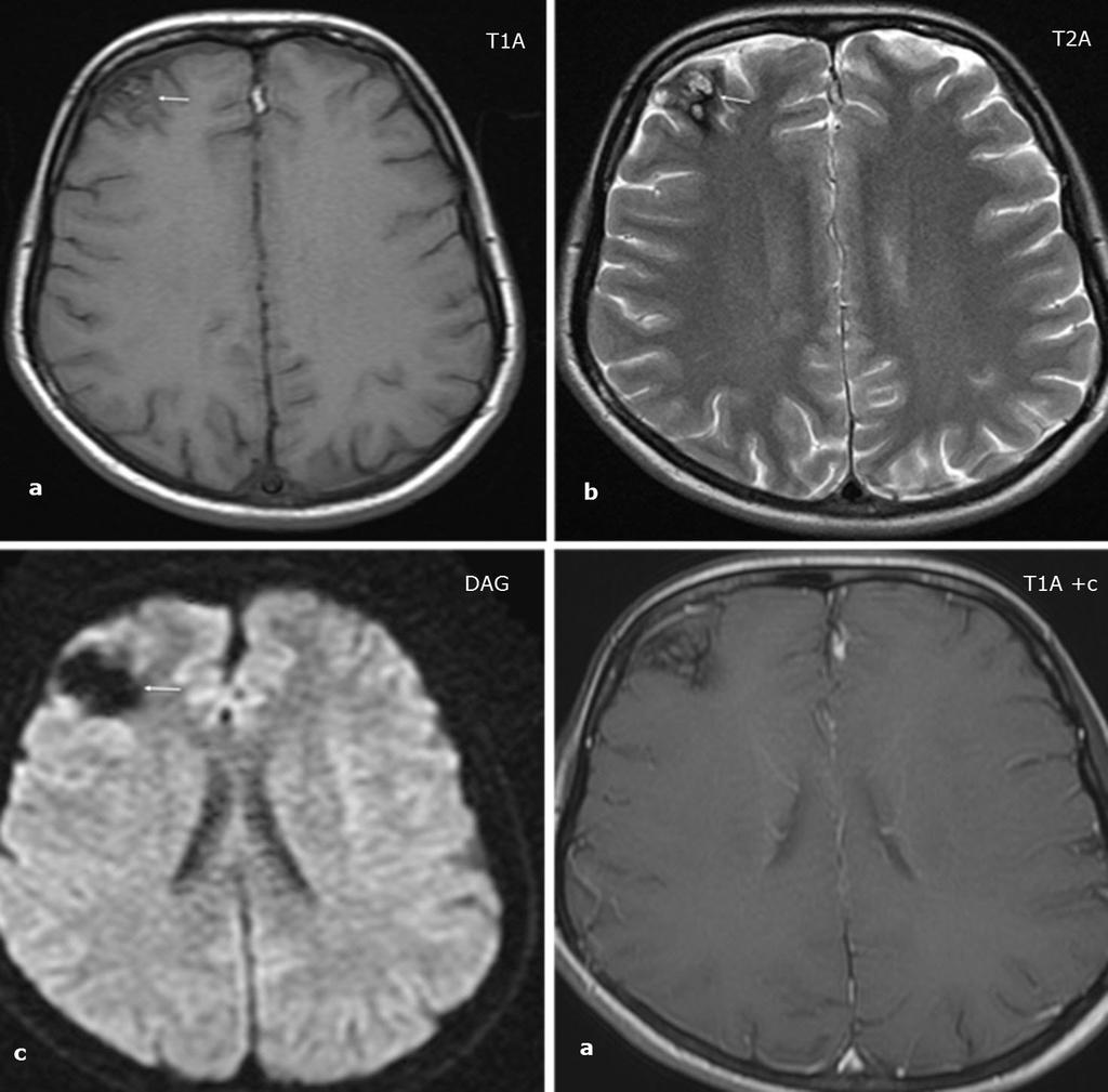 Kavernöz malformasyonlarda manyetik rezonans görüntüleme bulguları Resim 4. Elli bir yaşında erkek hasta, sağ serebral hemisfer yerleşimli Zabramski tip 2 kavernöz venöz malformasyon (KVM) olgusu.