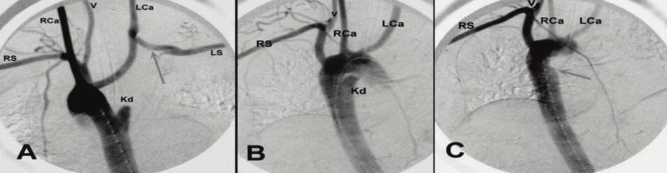 Mustafa ŞIRLAK ve ark. ŞEKİL 11: Distal iskemi bulgusu ile başvuran arteriyal TOS lu genç hastanın distal subklavyen arter anevrizmasının preoperatif 3 boyutlu rekonstrüksiyon görüntüsü.