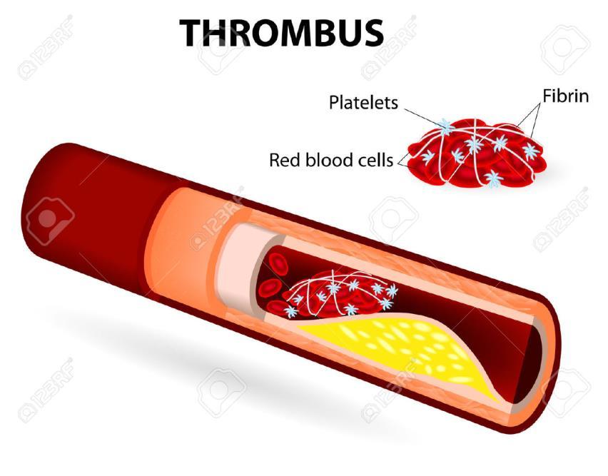 Bilindiği gibi kan pulcuklarının ve trombositlerin başlıca görevi damarların yaralanmalarında bir tıkaç (trombus) oluşturup kanamayı durdurmaktır.