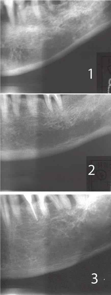 25 do ru çizilen hayali çizgi ile ölçüldü ü indeks, antegonial indeks (A ): mandibular ramusun yükselen ön duvar s n r ndan gonial bölgeye inilen düfley çizgi ile mandibular alt kortikal kemi in