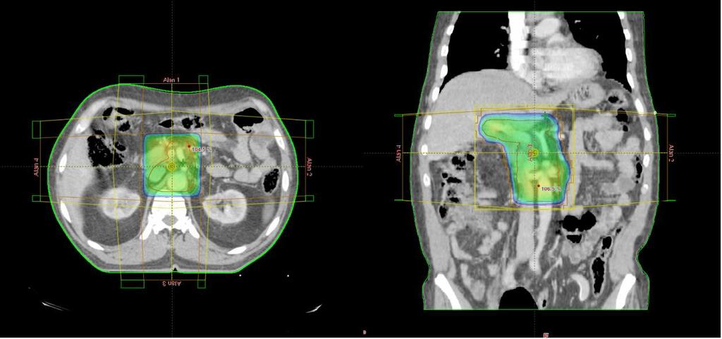 35 Şekil 3.19. Pankreas kanserli bir olguda 4alan 3BKRT planının TPS görüntüsü.