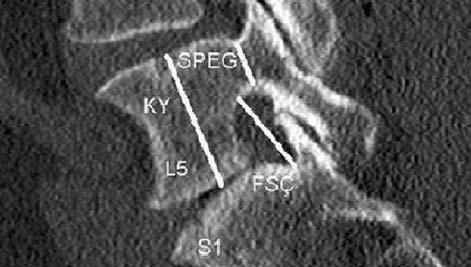 Korpus yüksekli i, L5- S1 foramen sagittal plan çap ve