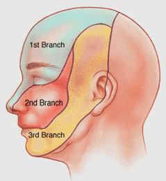 Trigeminal nevralji Şiddetli, 1 2 sn lik ağrı