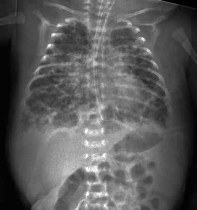 Normal ve Patolojik Pediatrik kciğer ve Toraks Radyografisi 107 Resim 10.,. Pulmoner interstisyel amfizem.