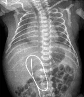 akciğer hacminde azalma ve yaygın hafif puslu görünüm izlenmektedir. Prematür infantta cilt altı yağlı dokunun ince olduğuna ve humerus başı epifizlerinin oluşmadığına dikkat ediniz.