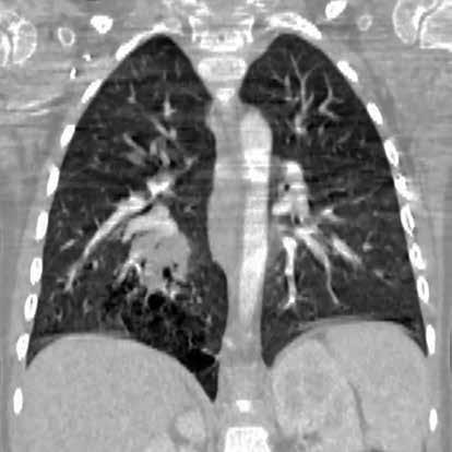 nterior mediastinal çizgi sağa doğru itilmiştir. Resim 12.,. Konjenital pulmoner hava yolu hastalığı.
