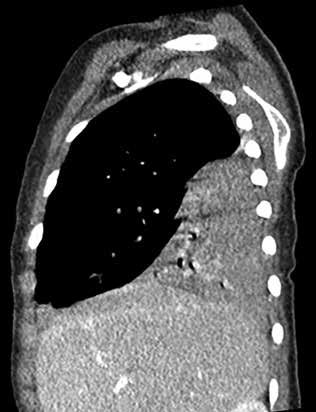 (D) Sagittal ultrasonografi kesitinde konsolide akciğer ve komşuluğunda az miktarda plevral efüzyon (*) izlenmektedir.