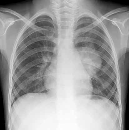 Normal ve Patolojik Pediatrik kciğer ve Toraks Radyografisi 111 bilir. Radyografide yumuşak doku dansitesinde iyi sınırlı yuvarlak kitle veya hava-sıvı seviyesi içeren kitle olarak izlenirler [21].