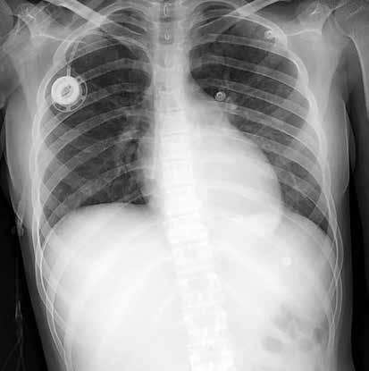 u nedenle akciğer radyografisi ile birlikte klinik ve laboratuvar bulguların birleştirilmesi halen en değerli tanı yöntemidir [18, 22].