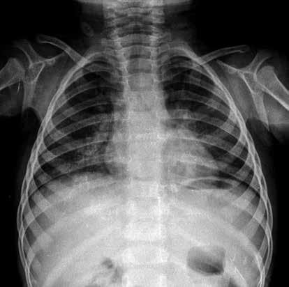 Normal ve Patolojik Pediatrik kciğer ve Toraks Radyografisi 113 Resim 18.,. akteriyel pnömoniyi taklit eden viral pnömoni.