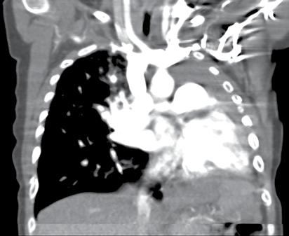 Normal ve Patolojik Pediatrik kciğer ve Toraks Radyografisi 115 EĞİTİCİ NOKT Resim 22.,. Pulmoner agenezi.