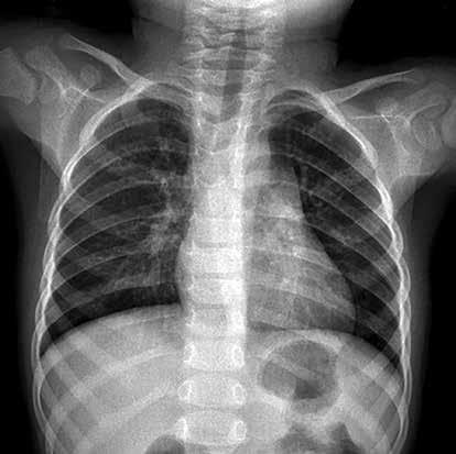 Normal ve Patolojik Pediatrik kciğer ve Toraks Radyografisi 99 Tablo 1: Konu başlıkları 1. Teknik 2. Normal bulgular ve varyasyonlar 3.
