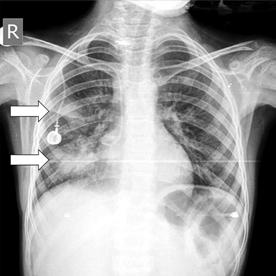 İnvazif pulmoner aspergilloziste radyografide düzensiz konturlu nodüller ve konsolidasyon alanları sık izlenir (Resim 26). Genelde plevral efüzyon izlenmez.