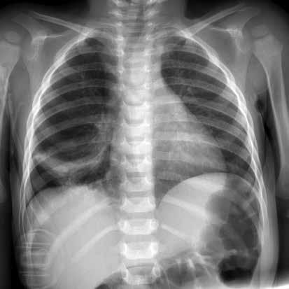 segmental/subsegmental atelektazi ile uyumlu alveoler opasite izlenmektedir. () Raptiye aspirasyonu olan 7 yaşındaki erkek hastada radyografide sağ ana bronşta raptiye izlenmektedir.