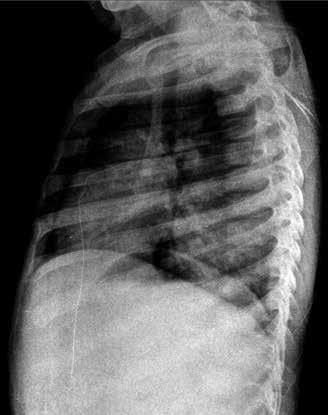 Osteosarkomlarda tipik olarak nodüllerde ossifikasyon vardır [30]. Trakeobronşial tümörlerin tanısında radyografinin yeri sınırlıdır.