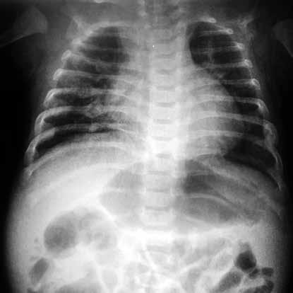 Normal ve Patolojik Pediatrik kciğer ve Toraks Radyografisi 123 Resim 33.,. Non-aksidental travma.