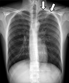 ni başlayan göğüs ağrısı ve nefes darlığı ile başvuran 17 yaşında astenik yapılı erkek hastanın radyografisinde () solda plevral boşlukta yaygın hava (oklar) ve santral kesimde sönmüş