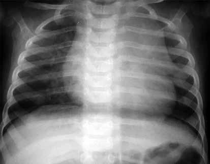 Normal ve Patolojik Pediatrik kciğer ve Toraks Radyografisi 103 Resim 5.,. Yelken bulgusu.