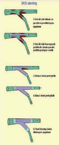 Stent balon şişirme süresinin minimal 30 sn olması önerilir. Açık ve geniş hücreli stentler kullanılmalıdır.