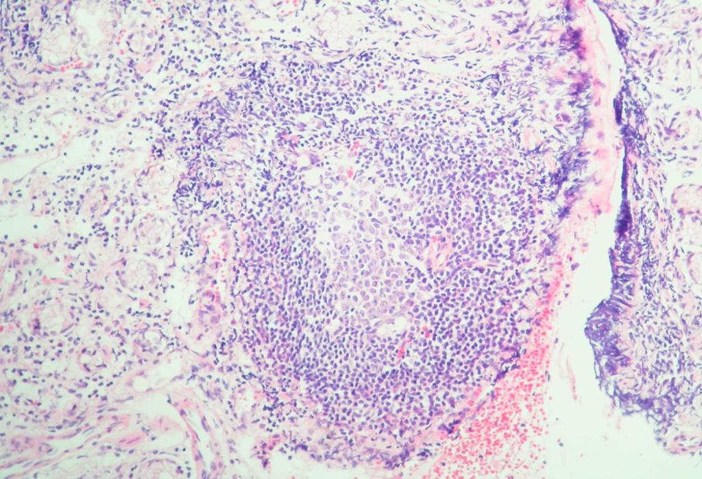 ve goblet hücre artışı ile karakterli intestinal metaplazi görülmekte (H&E,