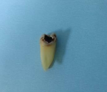 2.1. Makaslama Bağlanma Testi İçin Dentin Yüzeylerinin Hazırlanması Çalışmada kullanılacak dişlerin daimi molar diş olması ve aproksimal çürüğünün mine-sement birleşimine yakın olmasına dikkat edildi.