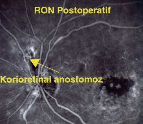 12 Cerrahi öncesi optik sinir başı muayenesine ve FA tetkikine göre nörotomi bölgesi olarak, büyük arter ve venlerden uzak, retinal hemoraji nedeniyle anatomik yapının maskelenmediği bölge seçildi.