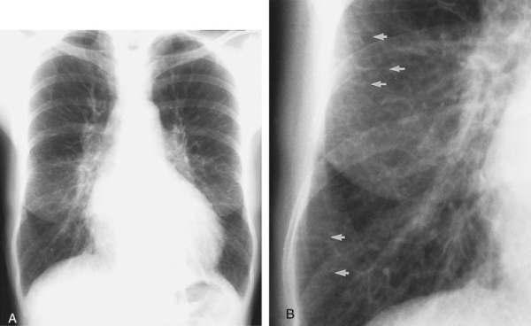 Konjestif Kalp Yetmezliğinde Erken Bulgular: - Kardiyomegali ve pulmoner damarlanmada artış - (Normalde vasküler gölgeler alt loblarda daha görünür olması