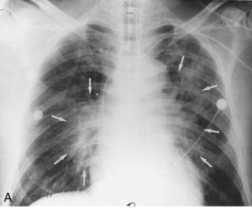 Pulmoner Ödem: Akciğerde hilus çevresindeki sıvı