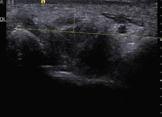 Median sinir yassılaşma oranın ultrasonografik ölçümü Fleksör retinakulum palmar yaylanması (PY) trapezial tuberkülden hamat kancaya çizilen çizginin orta noktasının