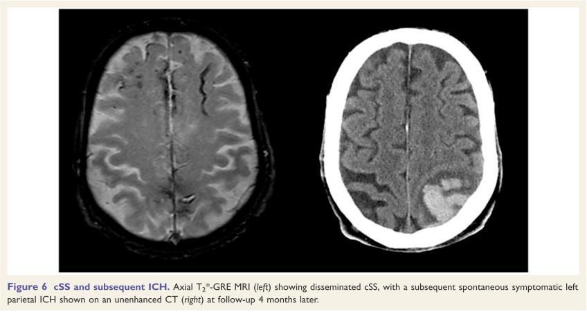 Charidimou A, Cortical superficial siderosis: detection and clinical significance in