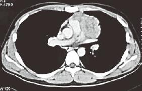 hastalık Mediastinal kitleden tekrar Bx: CD 20 ve MUM1 (+) CD15, CD30, EBER ve EBV-LMP (-) 2 kür EPOCH-R