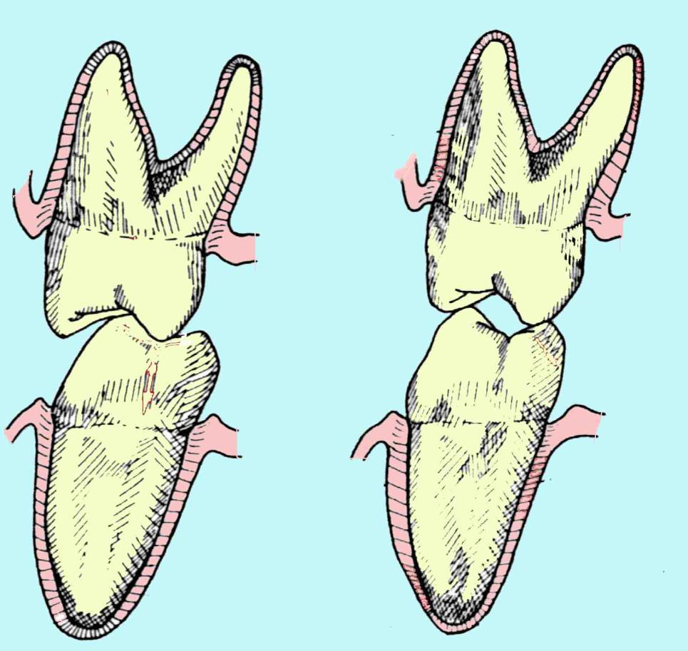 Fonksiyona girmeyen tüberküllerin rehberliği Sentrik oklüzyon dan lateral harekete geçişte fonksiyona girmeyen tüberküller mandibulaya