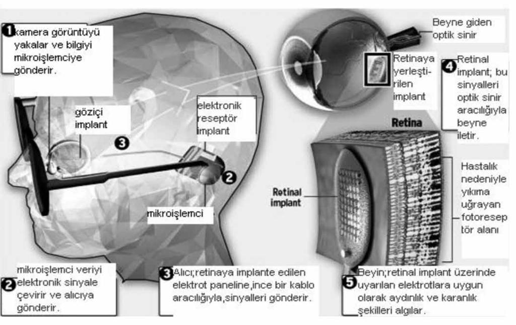 Biyonik Göz ve Oftalmolojide İleri Teknoloji Ganglion hücreleri zarar görmüş olanlar ve diyabet hastaları bunlar arasındadır.