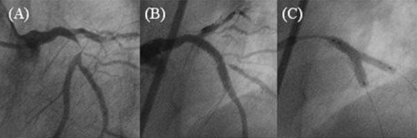 TAP Stentleme (T Stenting and Small Protrusion) A Burzotta ve ark.