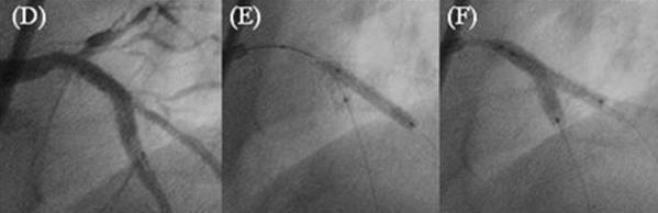 TAP Stentleme (T Stenting and Small Protrusion) A Burzotta ve ark.