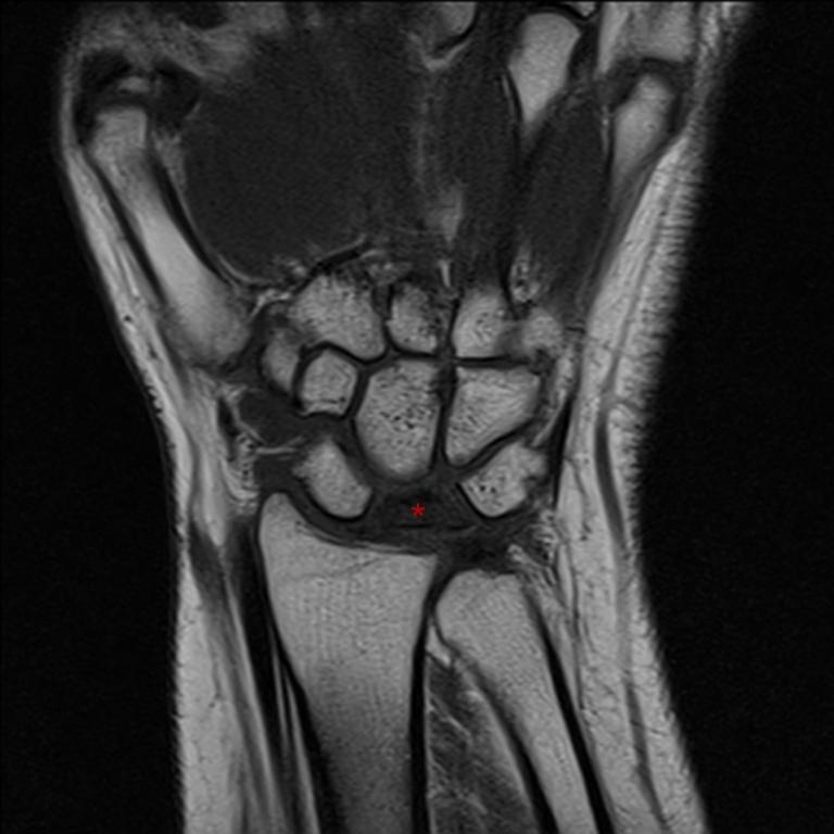 Skafoid distal polü ile trapeziodiumda dejeneratif osteofitik sivrileşmeler izlendi. Bu bulgular ile hastalığın evre 4 olduğuna karar verildi.