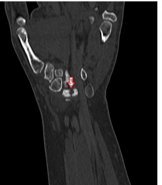 Şekil 2B : Sağ el bileği BT de sagittal (a) ve koronal (b) reformat görüntülerde; lunatum üç parça halinde izleniyor, parçalarda skleroz mevcut.