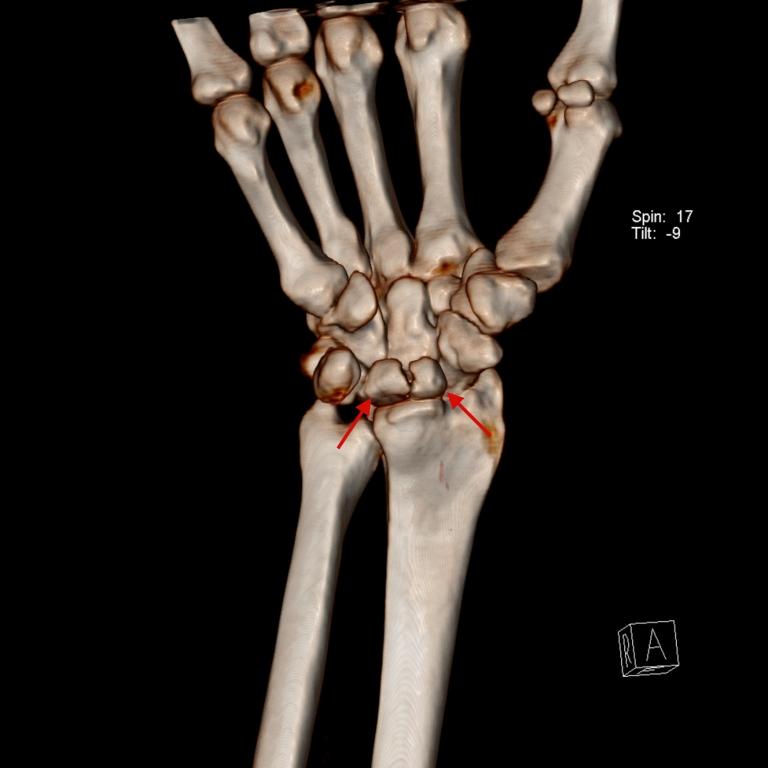 Şekil 2C : Sağ el bileği BT de sagittal (a) ve koronal (b) reformat görüntülerde; lunatum üç parça halinde izleniyor, parçalarda skleroz mevcut.