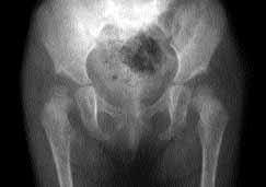 Geliflimsel kalça displazisinde Salter ve Pemberton pelvik osteotomi uygulamalar n n orta dönem sonuçlar 9 TABLO II Modifiye McKay ölçütlerine göre klinik de erlendirme [5] I Çok iyi Stabil, a r yok,